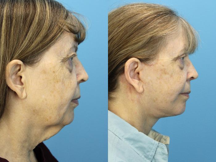 Before & After Facelift Case 539 Right Side View in West Des Moines & Ames, IA