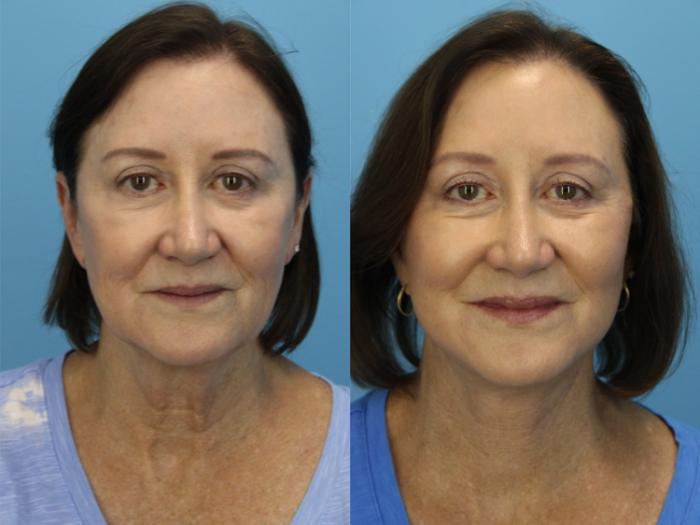 Before & After Facelift Case 562 Front View in West Des Moines & Ames, IA