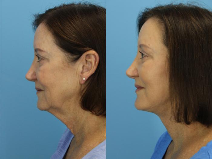 Before & After Facelift Case 562 Left Side View in West Des Moines & Ames, IA