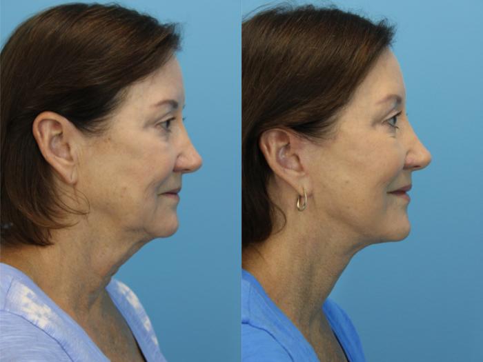 Before & After Facelift Case 562 Right Side View in West Des Moines & Ames, IA