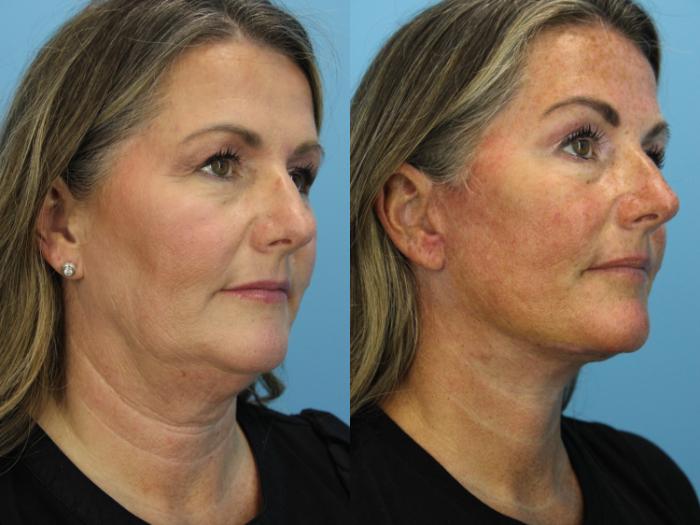 Before & After Facial Liposuction Case 563 Right Oblique View in West Des Moines & Ames, IA