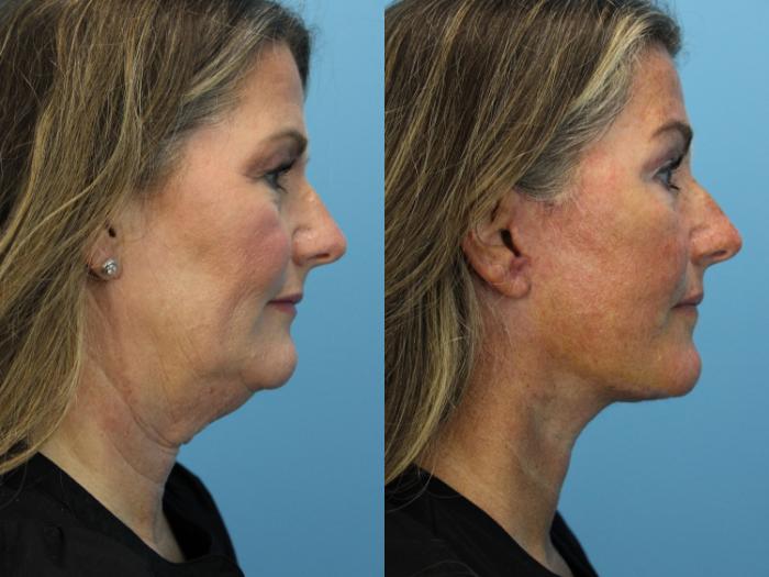 Before & After Facial Liposuction Case 563 Right Side View in West Des Moines & Ames, IA