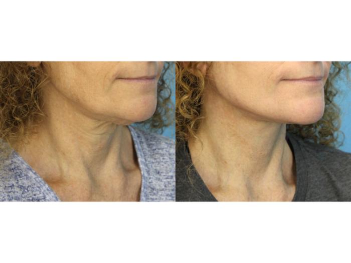 Before & After Facelift Case 585 Left Oblique View in West Des Moines & Ames, IA