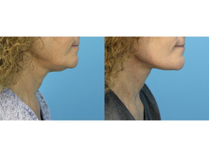 Before & After Facelift Case 585 Left Side View in West Des Moines & Ames, IA