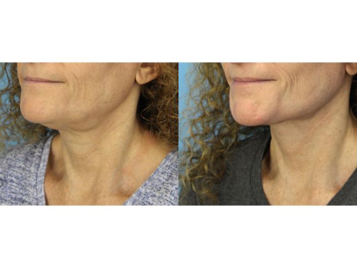 Before & After Facelift Case 585 Right Oblique View in West Des Moines & Ames, IA
