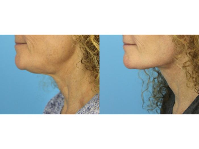 Before & After Facelift Case 585 Right Side View in West Des Moines & Ames, IA