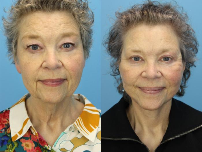 Before & After Facial Liposuction Case 590 Front View in West Des Moines & Ames, IA