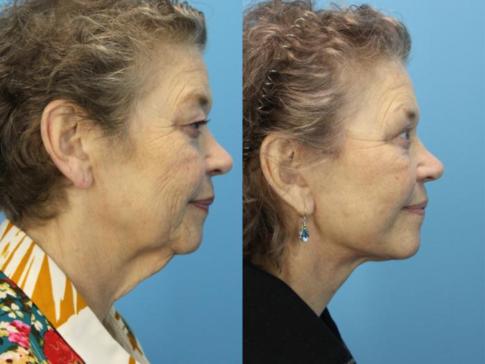 Before & After Facial Liposuction Case 590 Left Side View in West Des Moines & Ames, IA