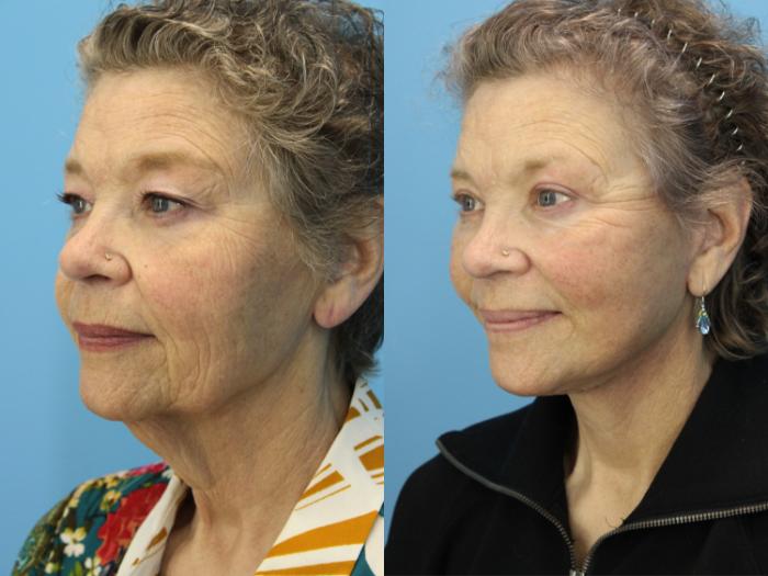 Before & After Facial Liposuction Case 590 Right Oblique View in West Des Moines & Ames, IA