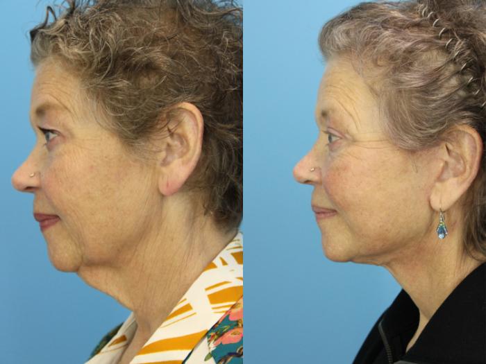 Before & After Facial Liposuction Case 590 Right Side View in West Des Moines & Ames, IA