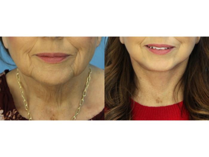 Before & After Facelift Case 591 Front View in West Des Moines & Ames, IA