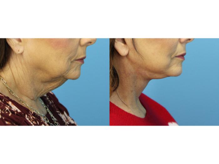 Before & After Facelift Case 591 Left Side View in West Des Moines & Ames, IA