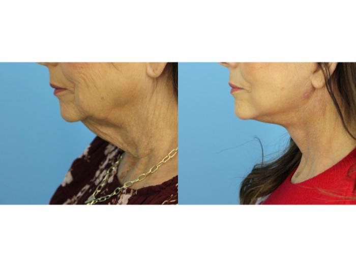 Before & After Facelift Case 591 Right Side View in West Des Moines & Ames, IA