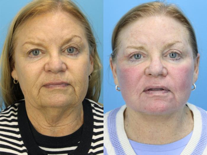 Before & After Facelift Case 607 Front View in West Des Moines & Ames, IA