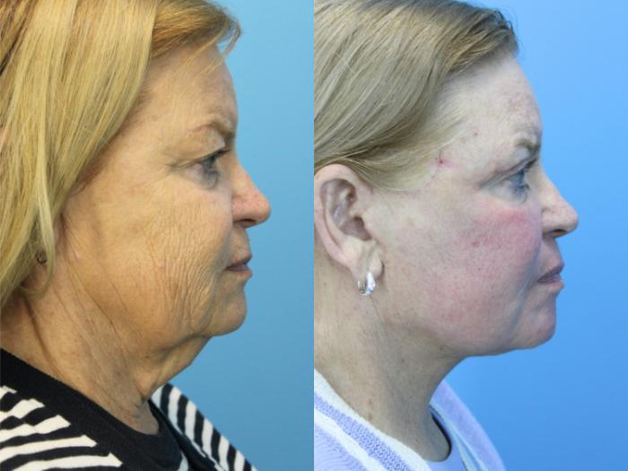 Before & After Facelift Case 607 Left Side View in West Des Moines & Ames, IA