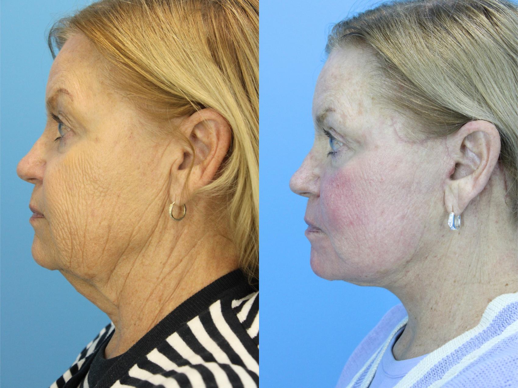 Before & After Facelift Case 607 Right Side View in West Des Moines & Ames, IA