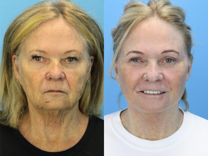 Before & After Facelift Case 608 Front View in West Des Moines & Ames, IA