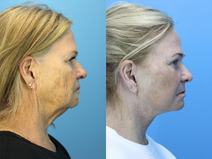 Before & After Facelift Case 608 Left Side View in West Des Moines & Ames, IA