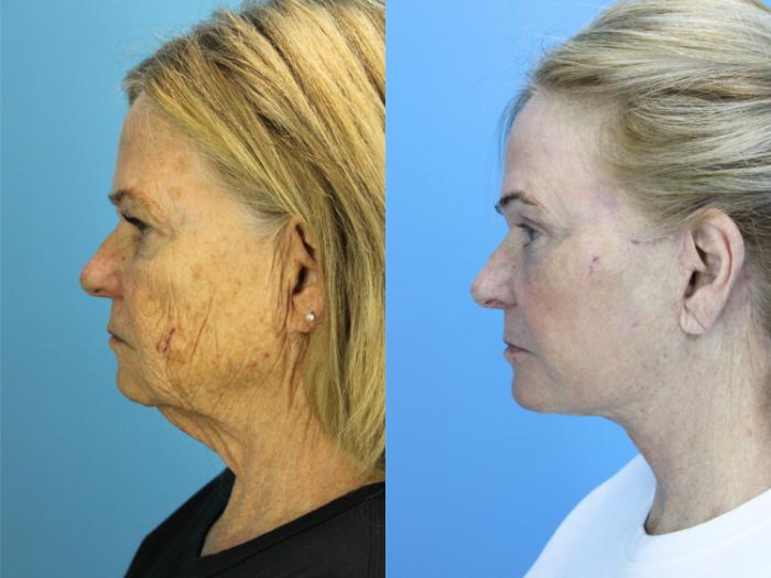 Before & After Facelift Case 608 Right Side View in West Des Moines & Ames, IA