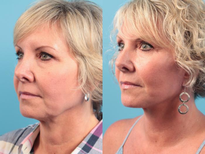 Before & After Facelift Case 61 View #1 View in West Des Moines & Ames, IA