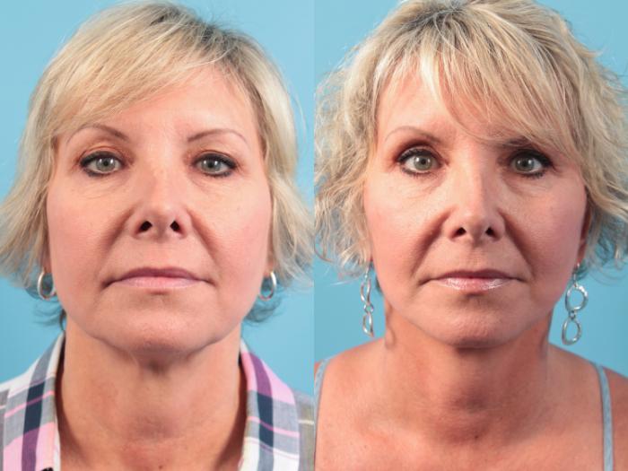 Before & After Facelift Case 61 View #2 View in West Des Moines & Ames, IA