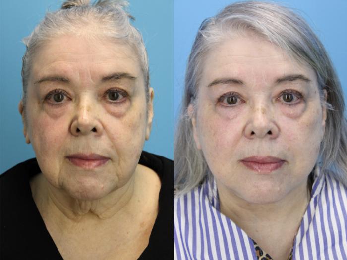 Before & After Facelift Case 619 Front View in West Des Moines & Ames, IA