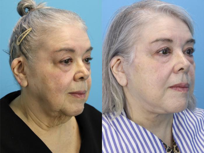 Before & After Facelift Case 619 Left Oblique View in West Des Moines & Ames, IA