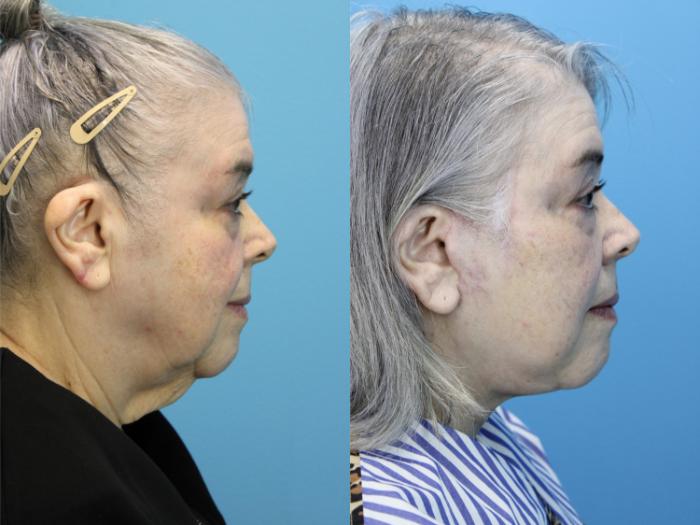 Before & After Facelift Case 619 Left Side View in West Des Moines & Ames, IA
