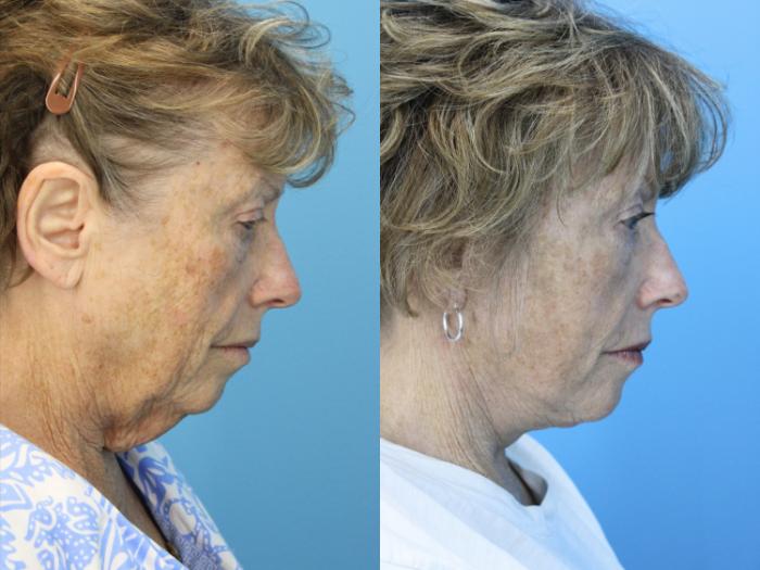 Before & After Facelift Case 636 Down View in West Des Moines & Ames, IA