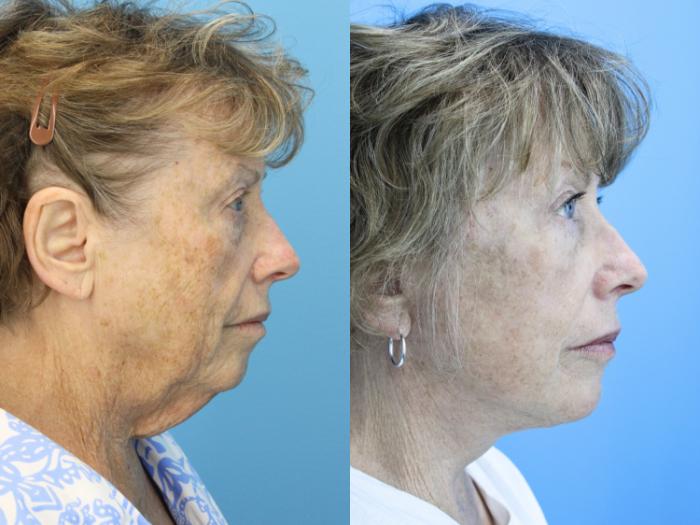 Before & After Facelift Case 636 Left Side View in West Des Moines & Ames, IA