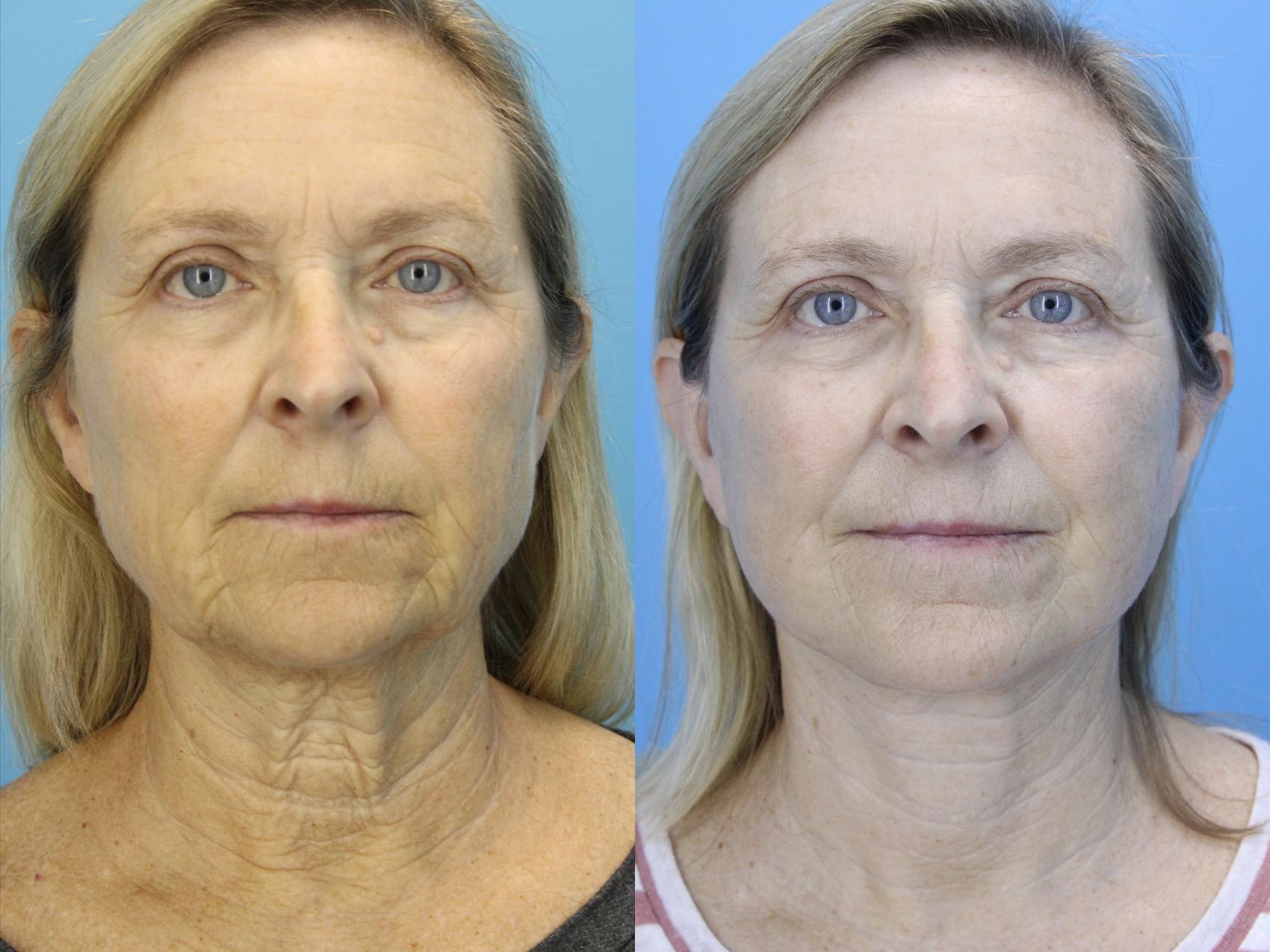 Before & After Facelift Case 638 Front View in West Des Moines & Ames, IA