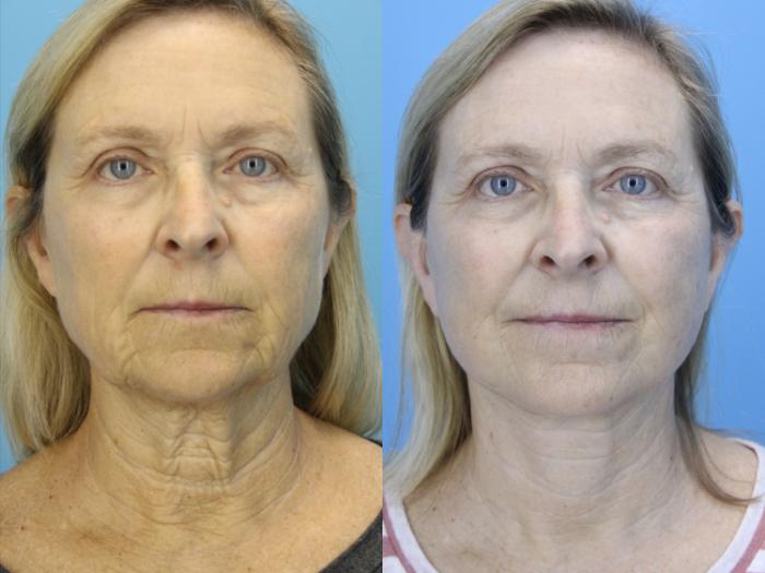 Before & After Facelift Case 638 Front View in West Des Moines & Ames, IA