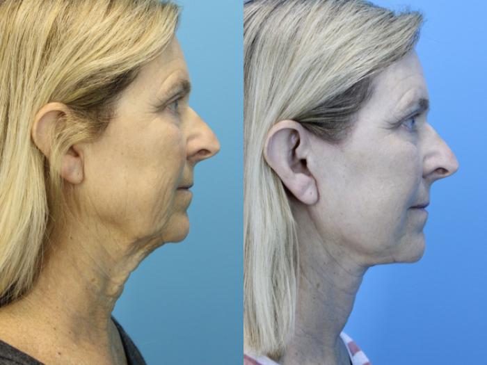 Before & After Facelift Case 638 Left Side View in West Des Moines & Ames, IA