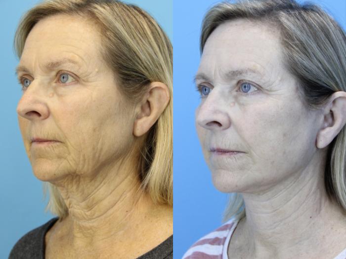 Before & After Facelift Case 638 Right Oblique View in West Des Moines & Ames, IA