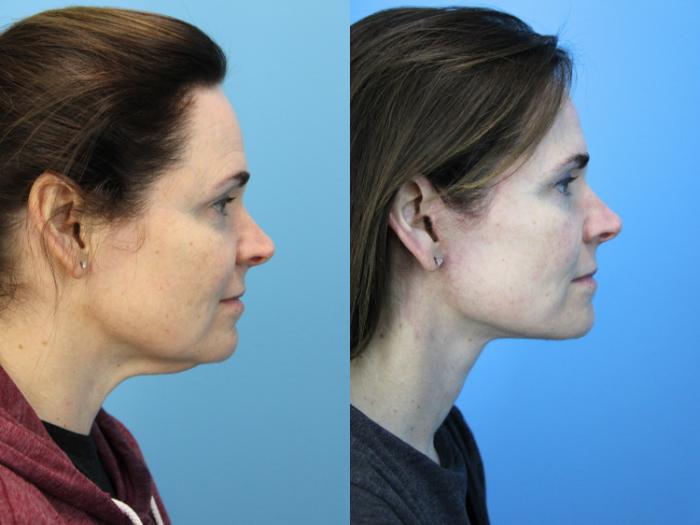 Before & After Facelift Case 658 Right Side View in West Des Moines & Ames, IA
