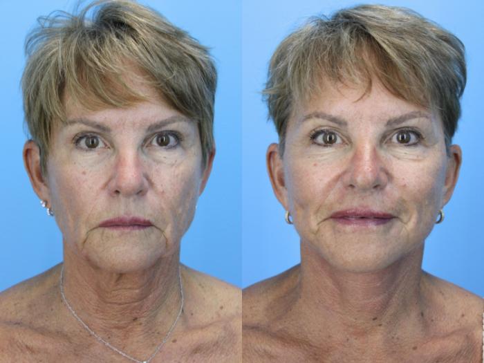 Before & After Facelift Case 662 Front View in West Des Moines & Ames, IA