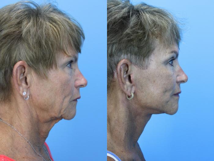 Before & After Facelift Case 662 Left Side View in West Des Moines & Ames, IA
