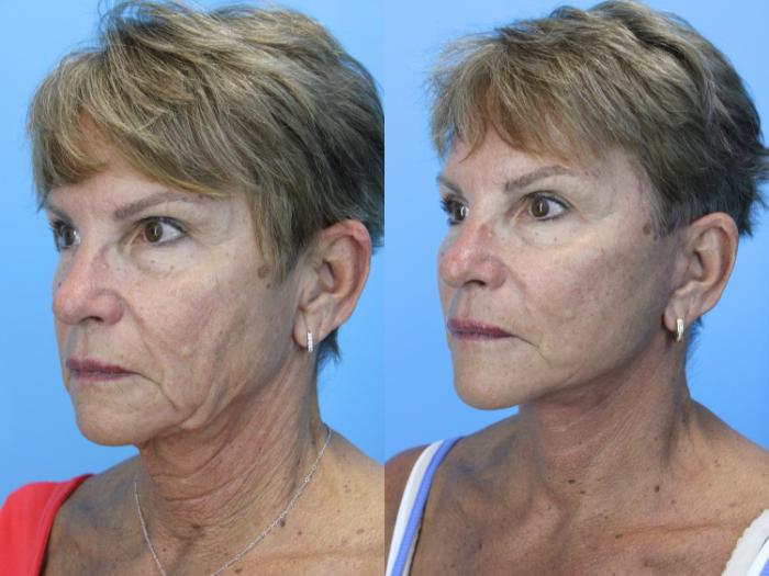 Before & After Facelift Case 662 Right Oblique View in West Des Moines & Ames, IA