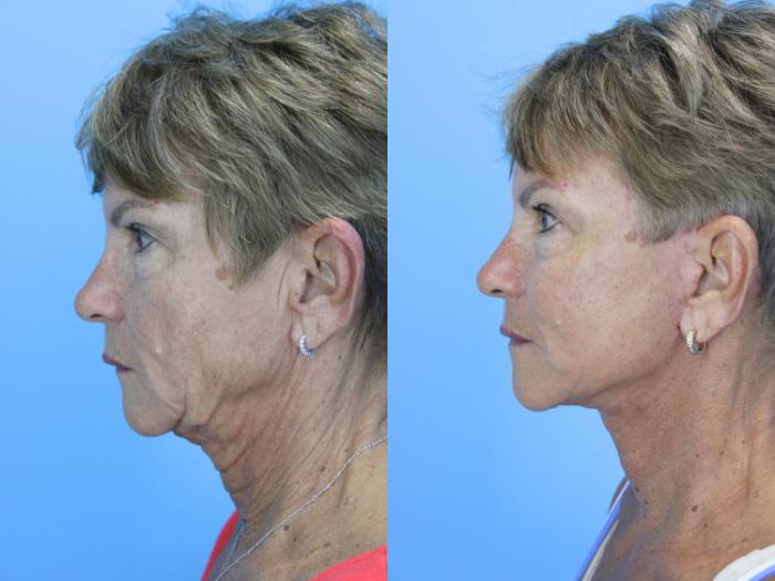 Before & After Facelift Case 662 Right Side View in West Des Moines & Ames, IA