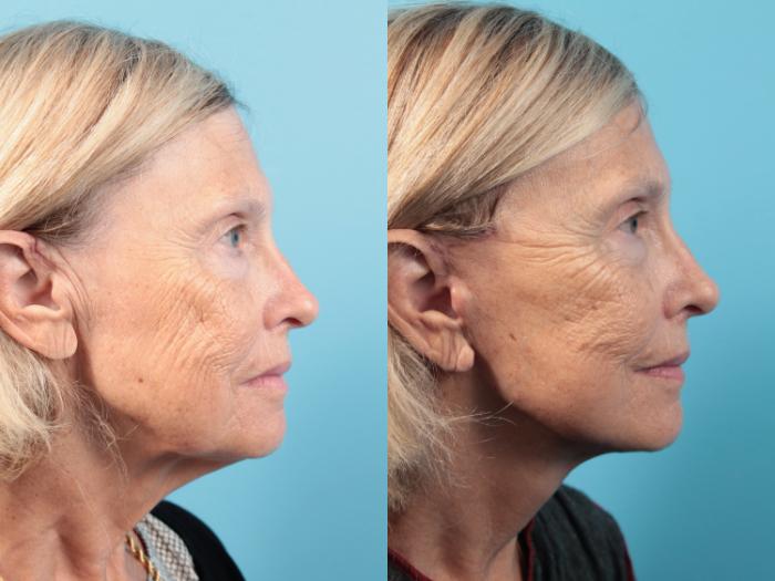 Before & After Facial Liposuction Case 89 View #2 View in West Des Moines & Ames, IA