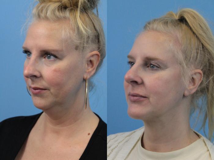 Before & After Chin Augmentation Case 226 Left Oblique View in West Des Moines & Ames, IA