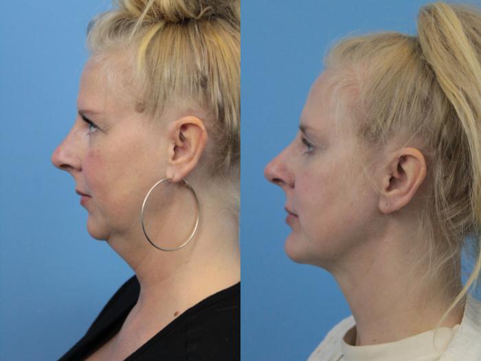 Before & After Chin Augmentation Case 226 Left Side View in West Des Moines & Ames, IA