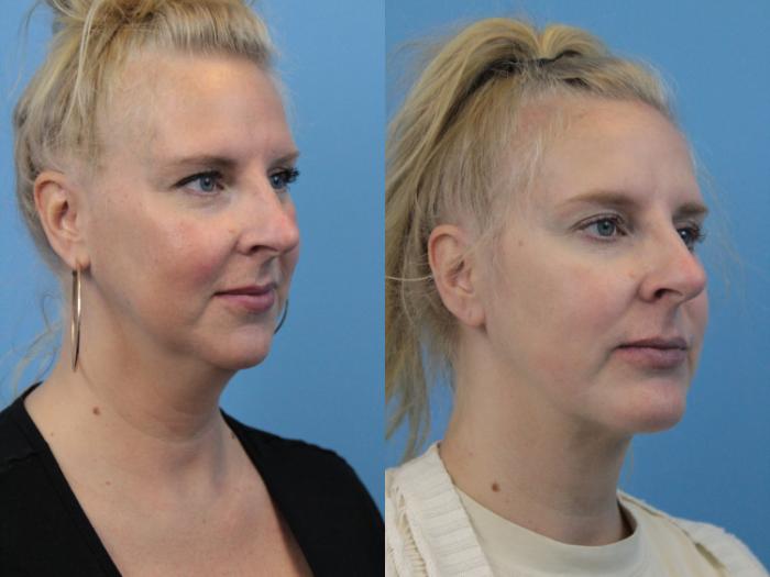 Before & After Facial Liposuction Case 226 Right Oblique View in West Des Moines & Ames, IA