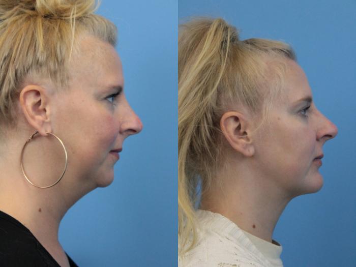Before & After Chin Augmentation Case 226 Right Side View in West Des Moines & Ames, IA