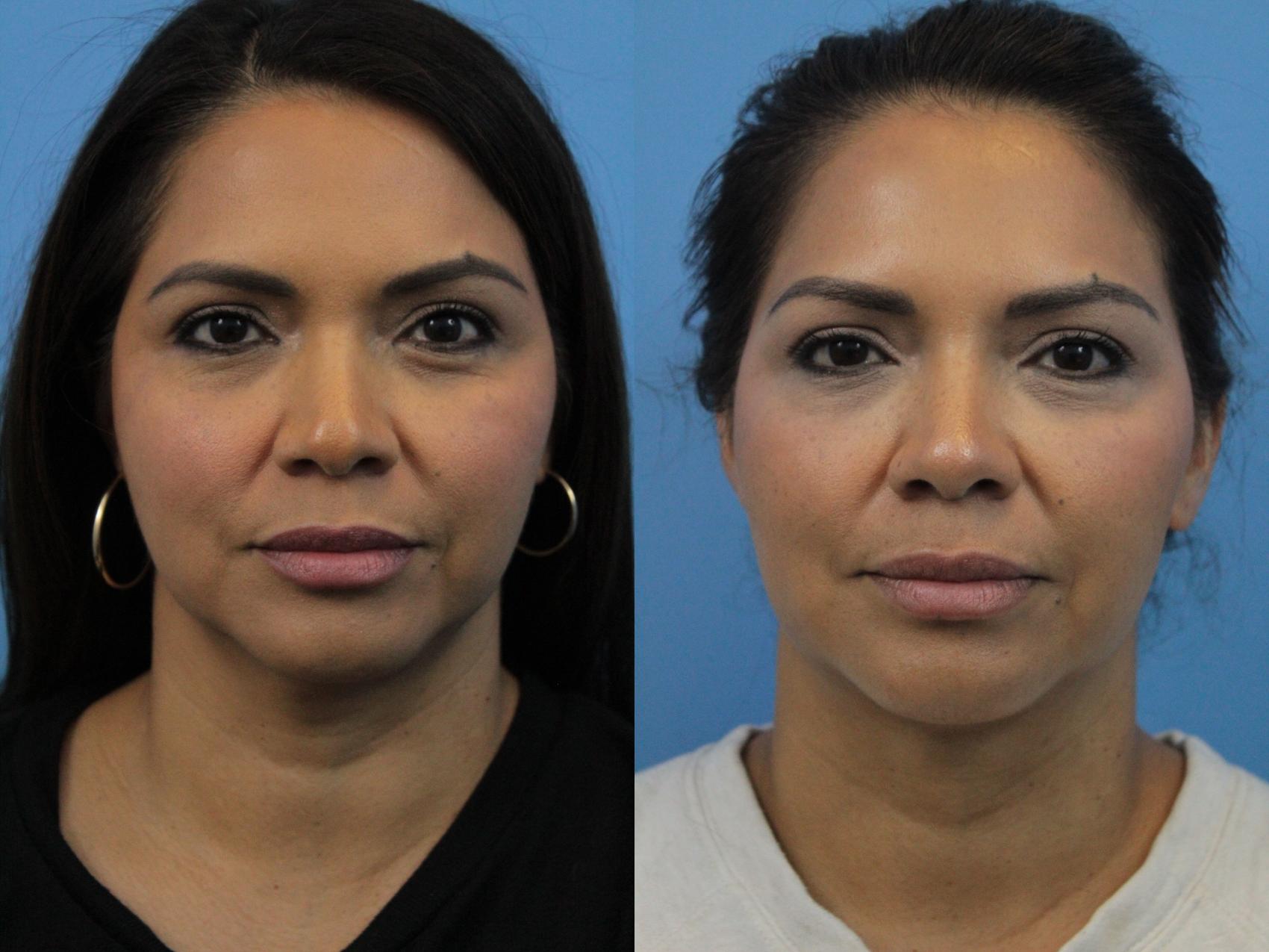 Before & After Non-Surgical Rhinoplasty Case 271 Front View in West Des Moines & Ames, IA