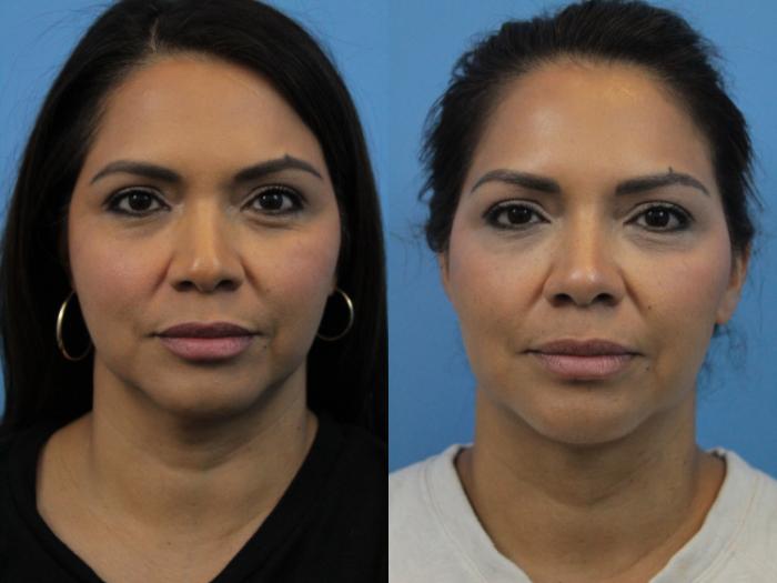 Before & After Facial Liposuction Case 271 Front View in West Des Moines, IA