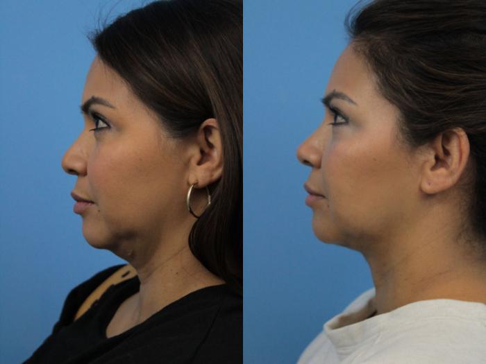 Before & After Non-Surgical Rhinoplasty Case 271 Left Side View in West Des Moines & Ames, IA
