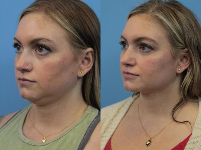 Before & After Facial Liposuction Case 303 Left Oblique View in West Des Moines & Ames, IA