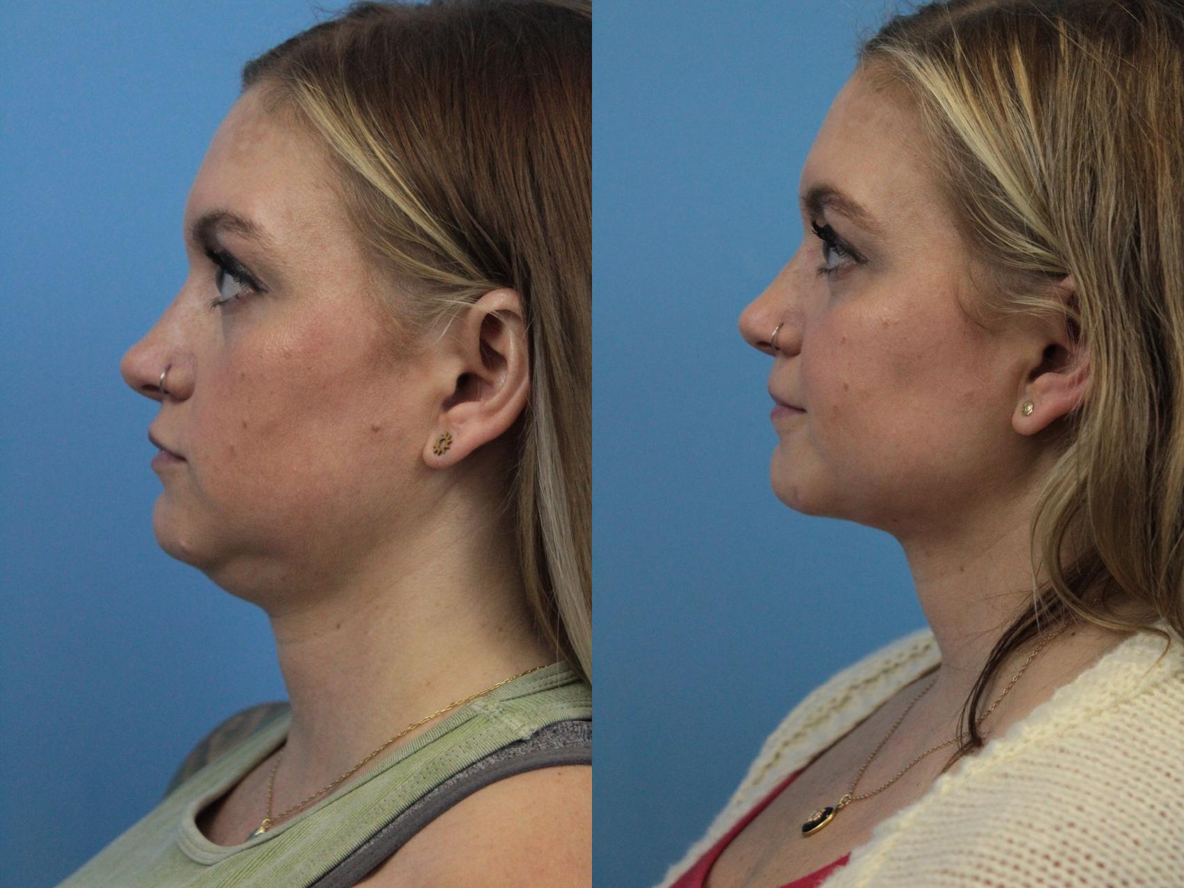 Before & After Facial Liposuction Case 303 Left Side View in West Des Moines & Ames, IA