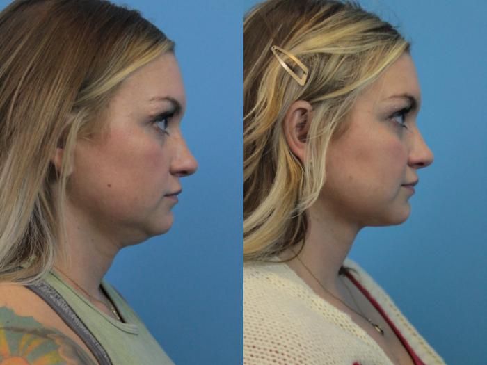 Before & After Facial Liposuction Case 303 Right Side View in West Des Moines & Ames, IA